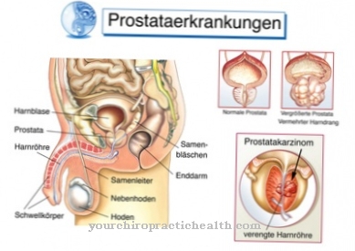 Csepegtető és prosztatagyulladás Öntözés a vérben prostatitisben