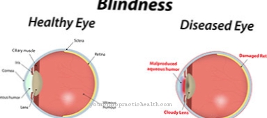 A látás megváltozásának oka hyperopiaról rövidlátásra