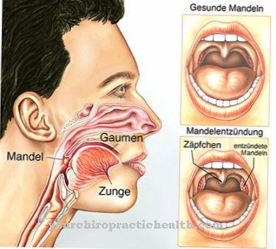 Penyakit adalah gejala tonsilitis Tonsilitis: Gejala,