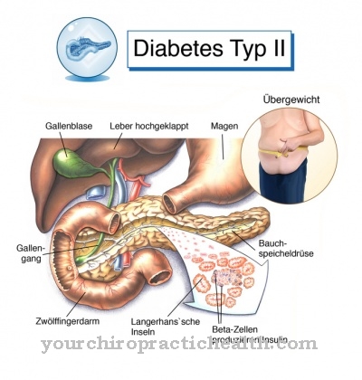 a kezelés ii típusú diabetes mellitus)