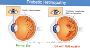 A diabéteszes retinopátia és tünetei
