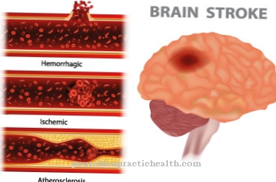 A KATP-csatornák szerepe az agyi ischaemiás stroke-ban és a cukorbetegségben