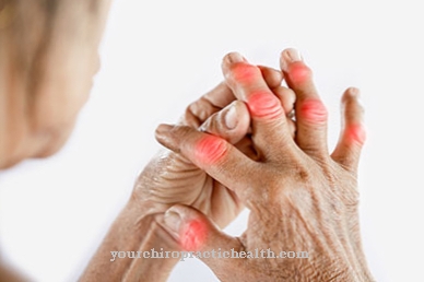 kas yra artrita tratamentul artrozei de gradul 2 al articulației umărului